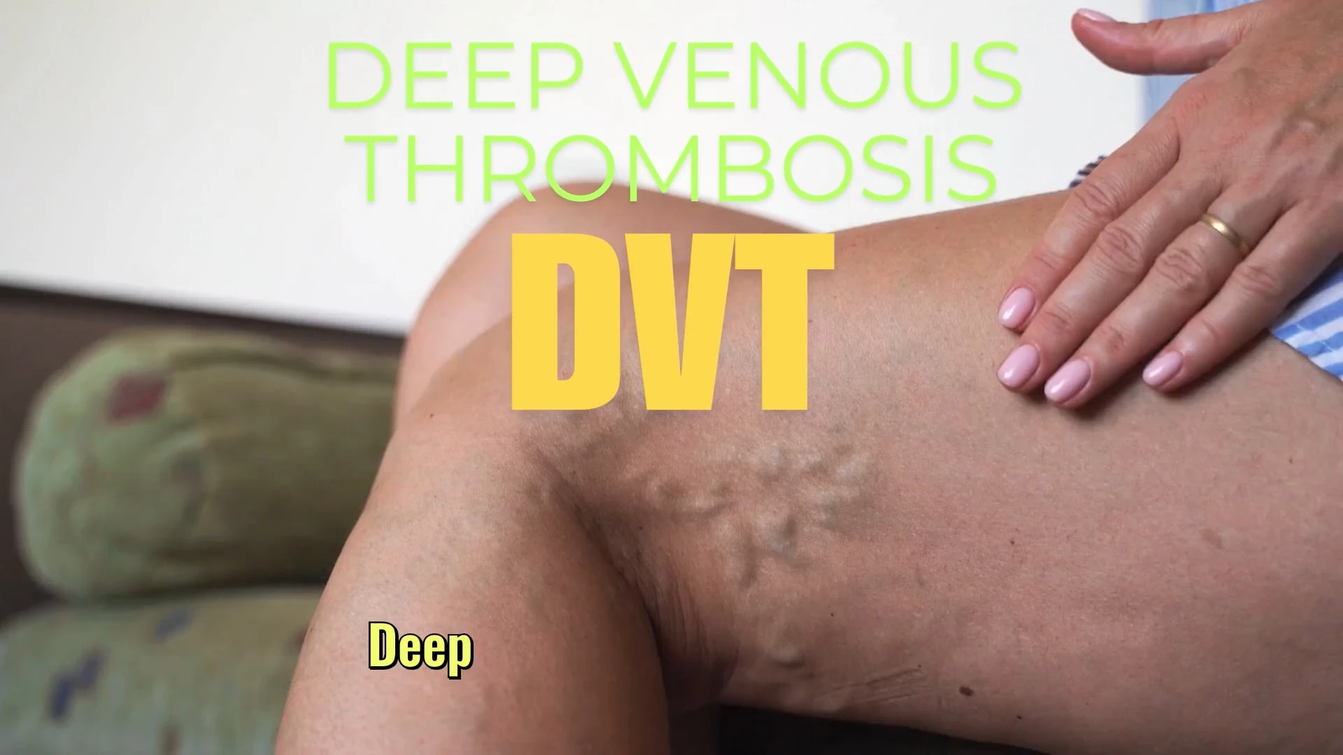 Infomercial 3: Deep venous thrombosis infomercial